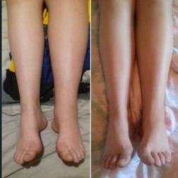 Limfedem nogu - klinički primer 2