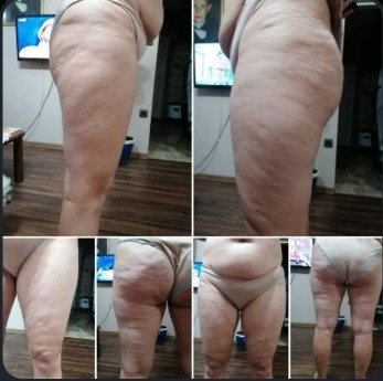 Lipedem nogu - klinički prikaz